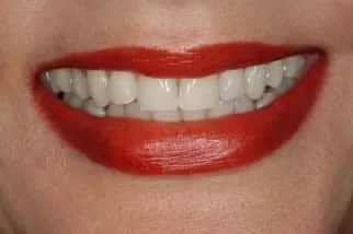 Before: two chipped front teeth with a visible gap. After: even, natural-looking front teeth with the gap closed.