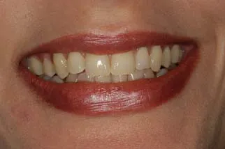 Before: two chipped front teeth with a visible gap. After: even, natural-looking front teeth with the gap closed.