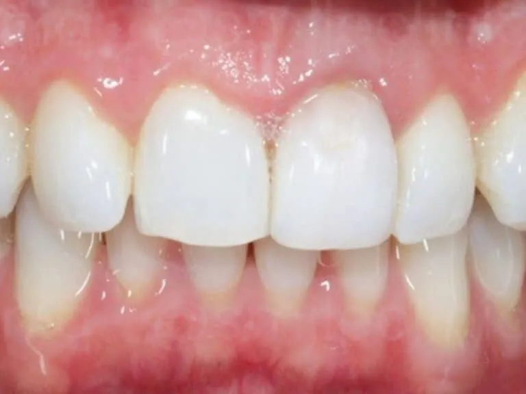Before: yellowed, stained teeth. After: the same teeth several shades whiter with a natural enamel tone.