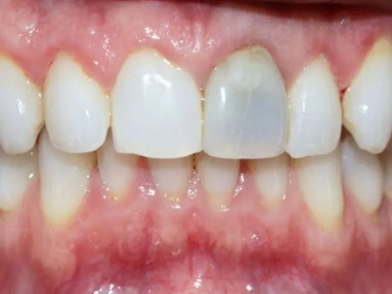 Before: yellowed, stained teeth. After: the same teeth several shades whiter with a natural enamel tone.