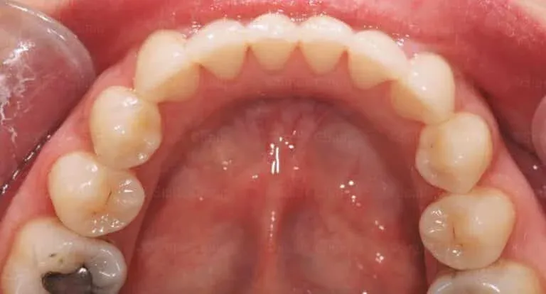 Before: crowded, overlapping lower front teeth. After: aligned lower teeth after clear aligner treatment.