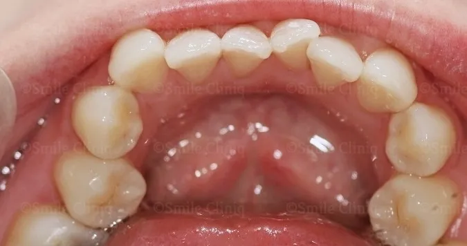 Before: crowded, overlapping lower front teeth. After: aligned lower teeth after clear aligner treatment.