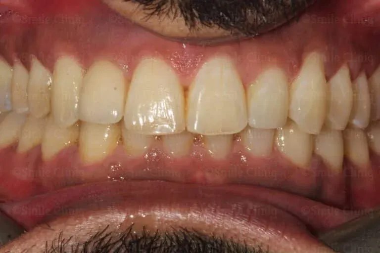 Before: a missing upper premolar leaving a dark gap. After: the gap restored with a natural-looking implant crown.