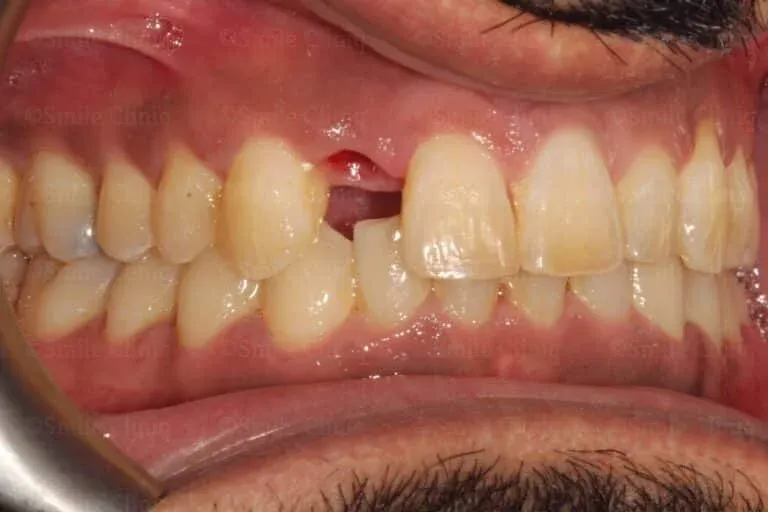 Before: a missing upper premolar leaving a dark gap. After: the gap restored with a natural-looking implant crown.